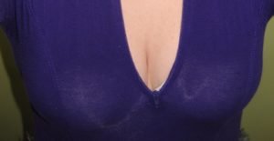 Cleavage enhancement